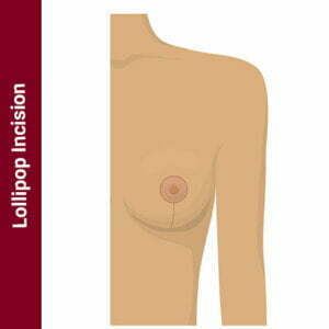 Lollipop incision