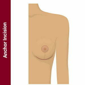 anchor incision