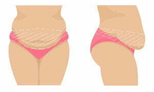 circular tummy tuck circular tummy tuck