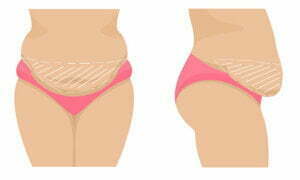 extended tummy tuck extended tummy tuck